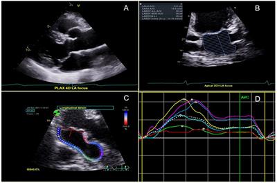 Stroke in mitral valve prolapse: risk factors and left atrial function in cryptogenic versus non-cryptogenic ischemic subtypes